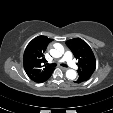 DeBakey classification | Radiology Reference Article | Radiopaedia.org