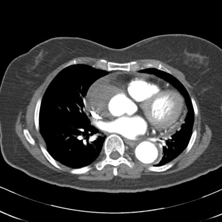 Aortic dissection - Stanford type A | Radiology Case | Radiopaedia.org