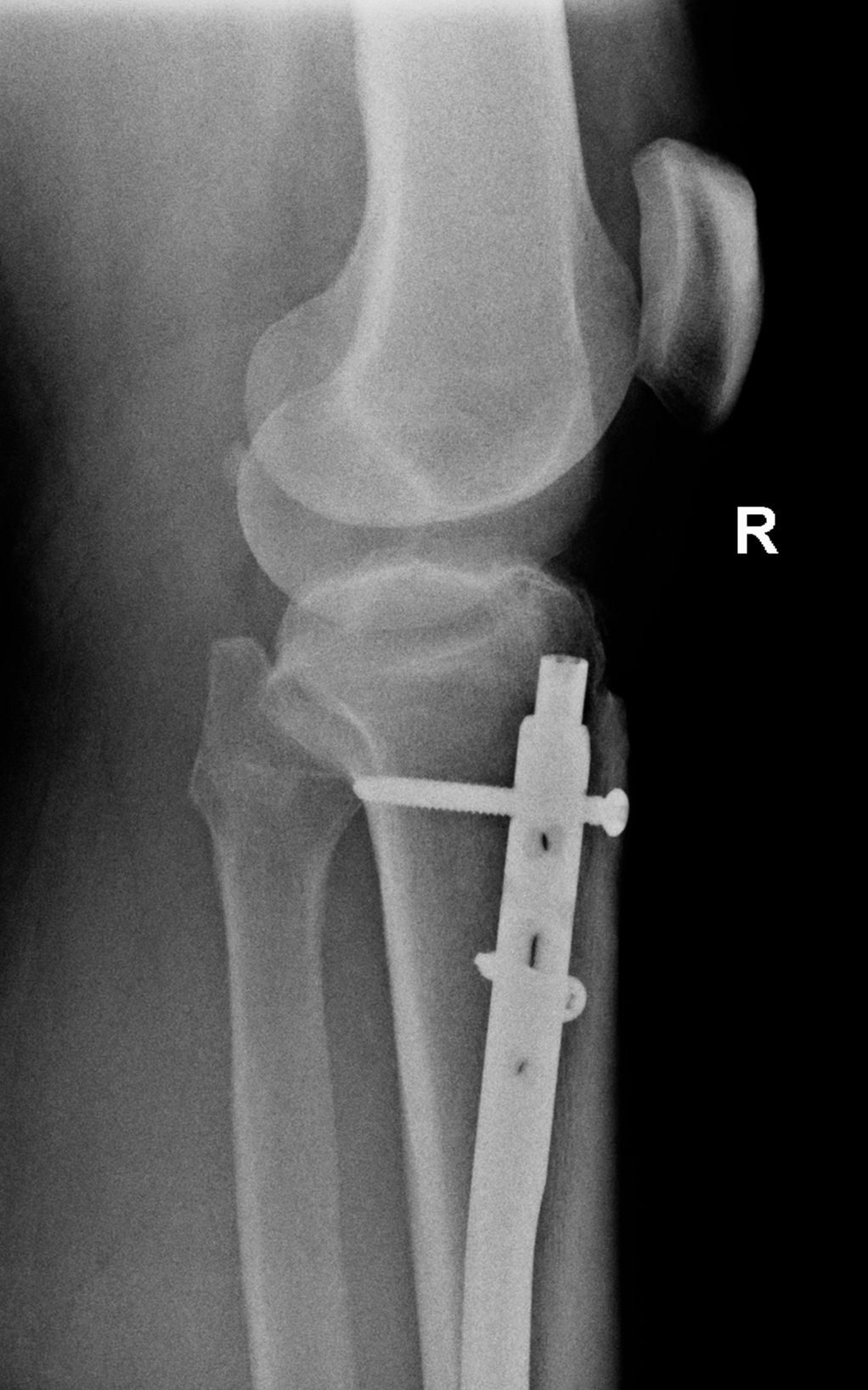 Displaced tibial intramedullary nail post fall and distal locking screw ...