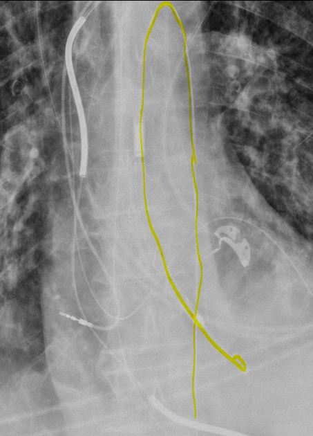 Breast implant placement comparison x-ray blue Vector Image