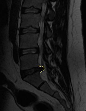 Disc protrusion impinging upon the descending left S1 nerve | Image ...