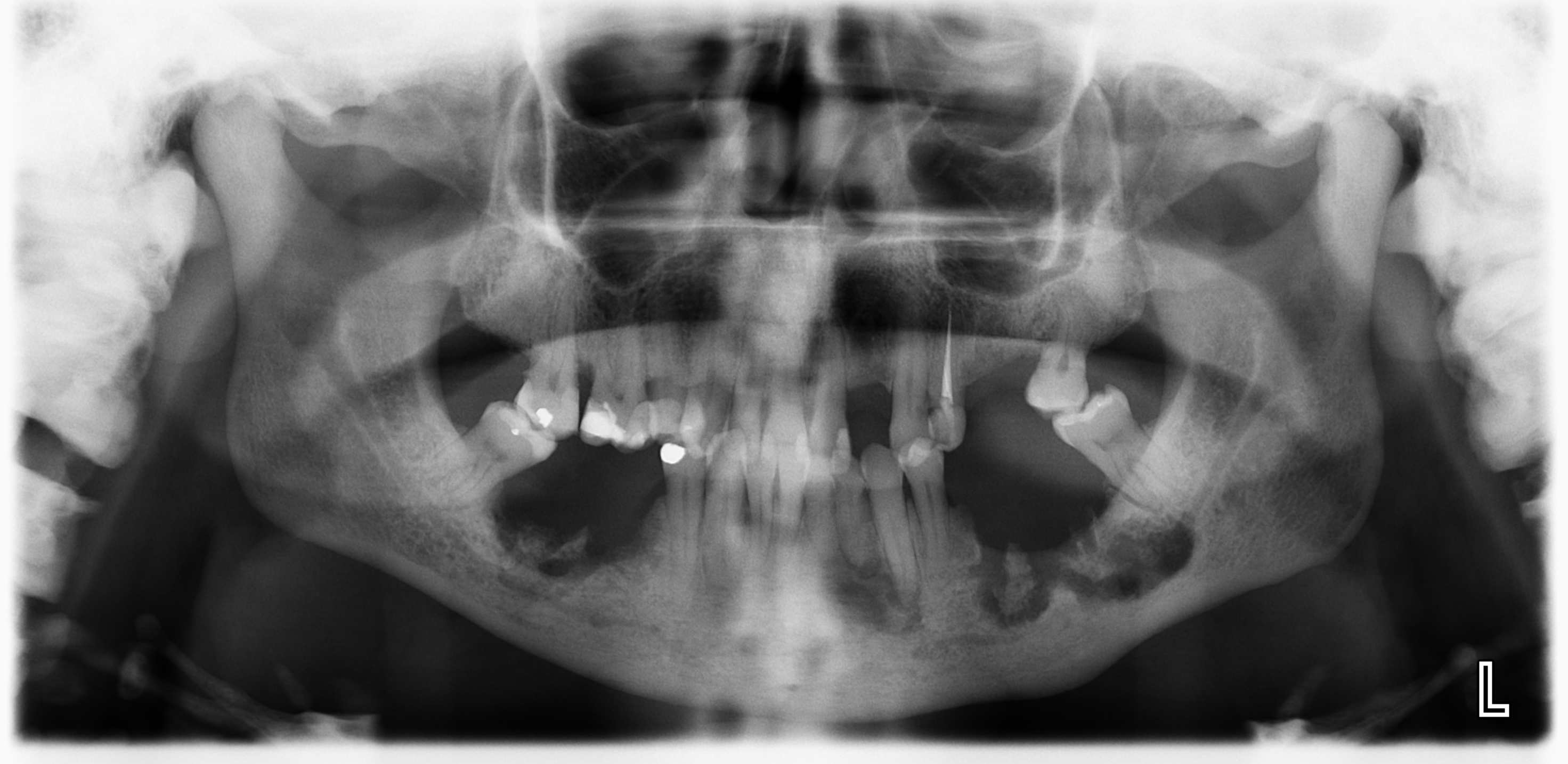 Osteopetrosis Histology