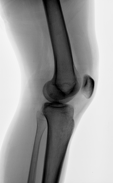 Knee joint effusion | Image | Radiopaedia.org