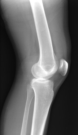 Knee Joint Effusion Radiology Case Radiopaedia Org