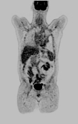 Mesothelioma Radiology Reference Article Radiopaedia Org