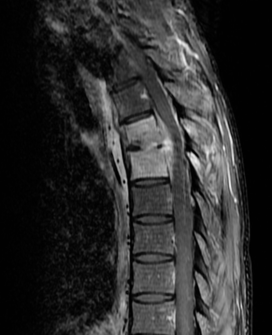 Discitis osteomyelitis with epidural phlegmon | Image | Radiopaedia.org