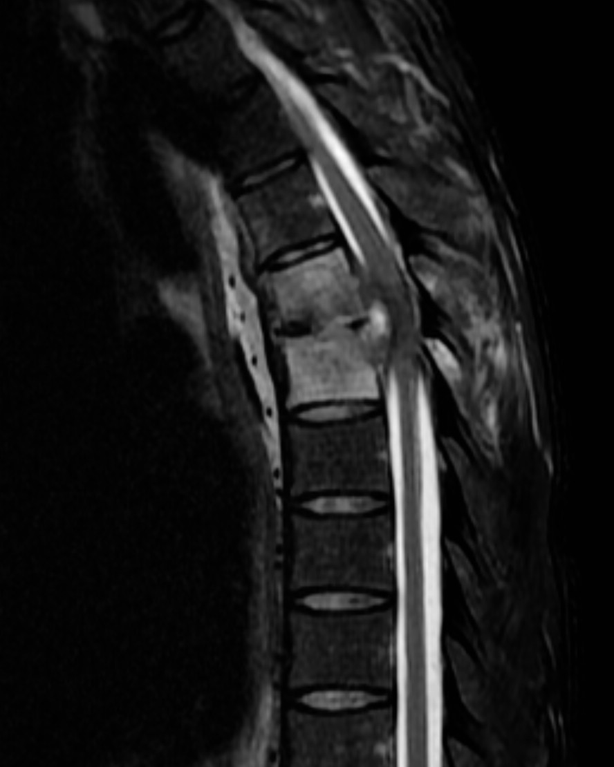 Discitis osteomyelitis with epidural phlegmon | Image | Radiopaedia.org