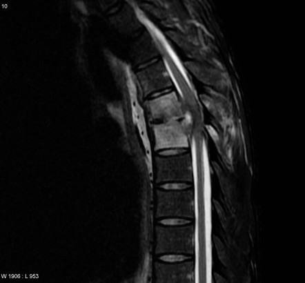 Spondylodiscitis | Radiology Reference Article | Radiopaedia.org