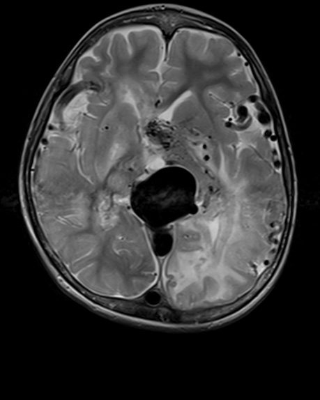 Vein of Galen malformation | Image | Radiopaedia.org