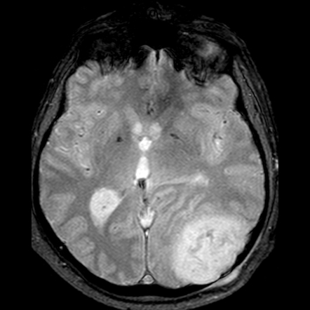 Intracranial epidermoid cyst - posterior fossa | Image | Radiopaedia.org