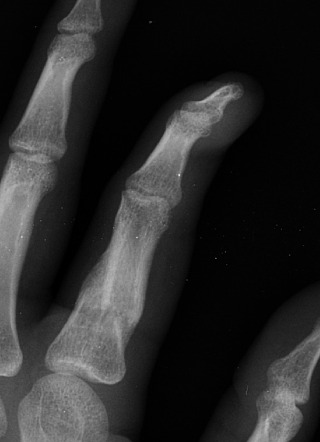 Malunited fracture - tibia, Radiology Case