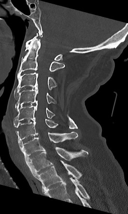 Cervical spine fracture - chalk stick | Radiology Case | Radiopaedia.org