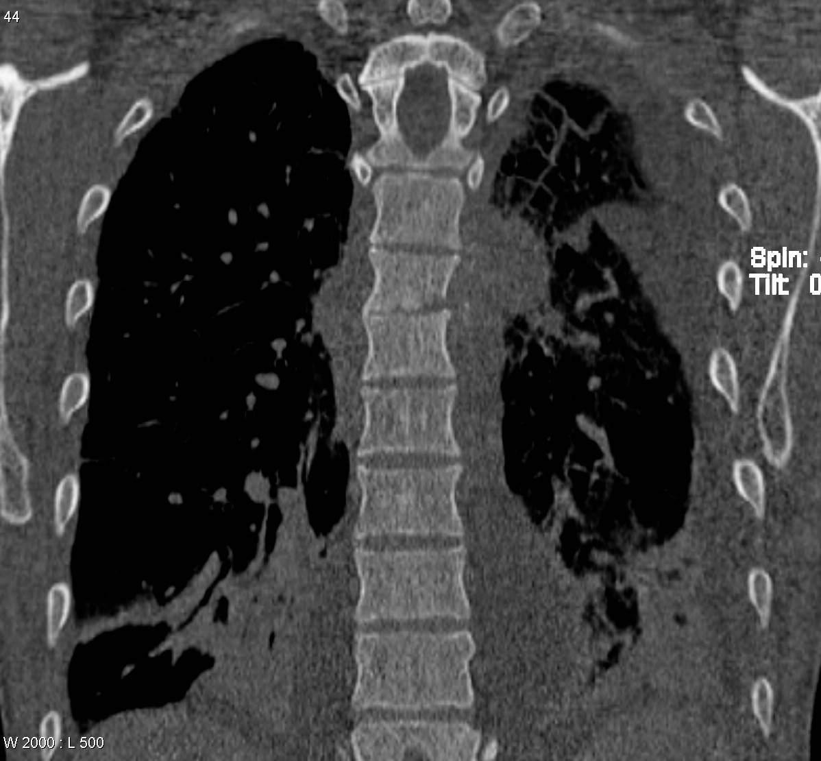 Discitis Osteomyelitis With Epidural Phlegmon | Image | Radiopaedia.org