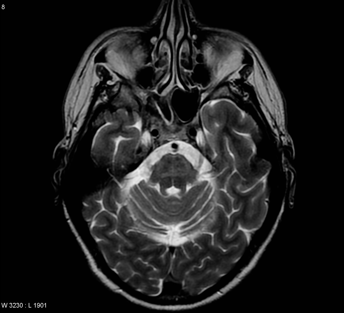 Multisystem Atrophy Msa Image 6154