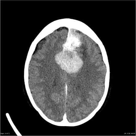 Atypical meningioma | Image | Radiopaedia.org