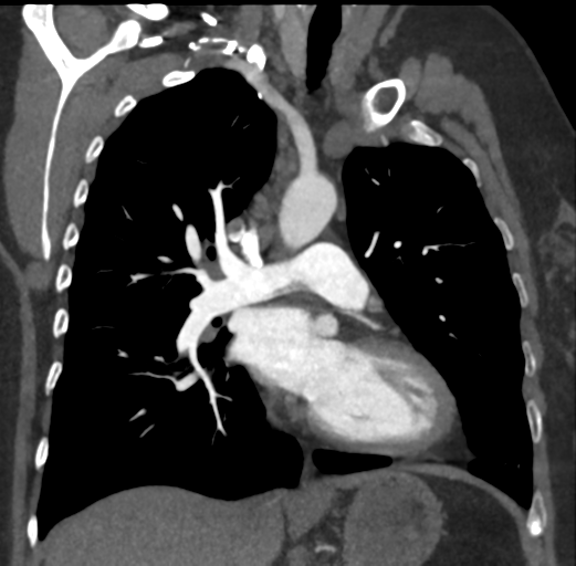 Chronic pulmonary embolus | Image | Radiopaedia.org