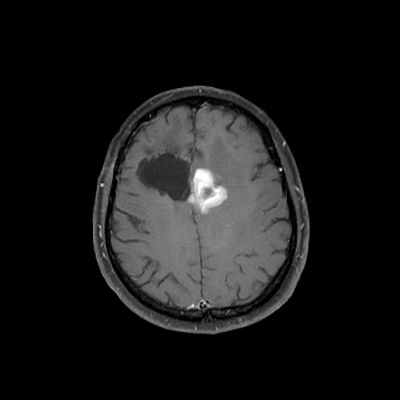 Recurrent primary CNS lymphoma | Radiology Case | Radiopaedia.org