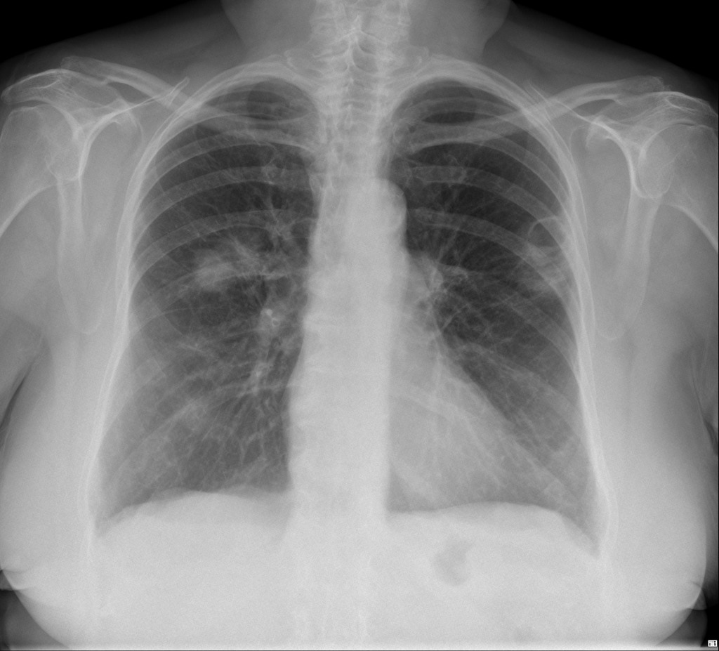 Synchronous Lung Cancers Radiology Case Radiopaedia Org