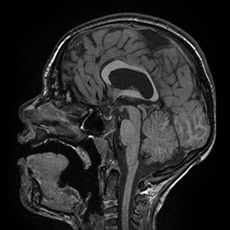 Schizencephaly - bilateral | Image | Radiopaedia.org