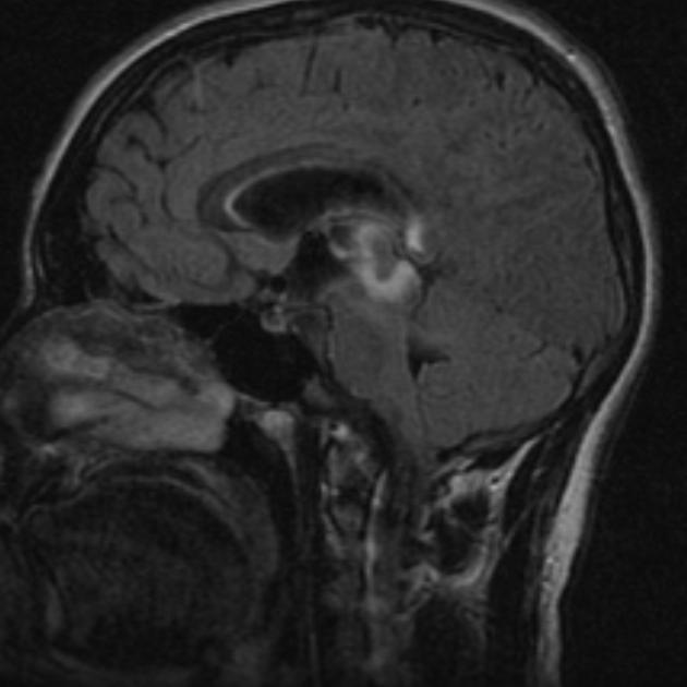 Pineal germinoma | Radiology Reference Article | Radiopaedia.org