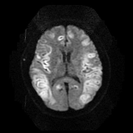 Hypoglycemic encephalopathy | Radiology Reference Article | Radiopaedia.org