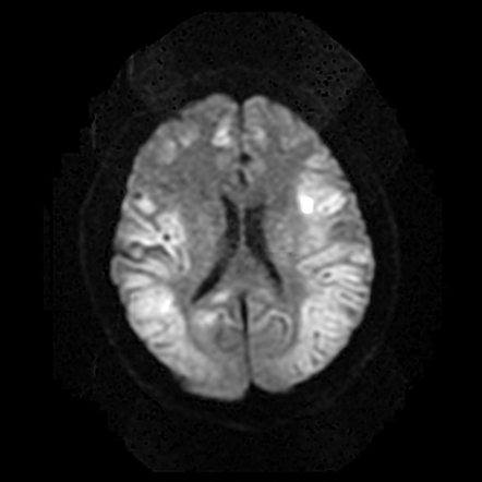 Hypoglycemic encephalopathy | Radiology Case | Radiopaedia.org