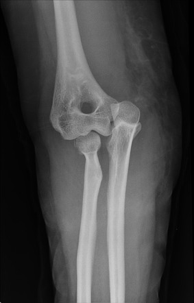 Elbow Dislocation With Radial Head Fracture 