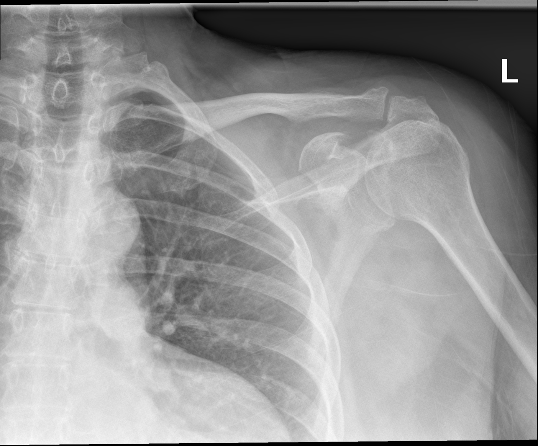 X Ray Normal Shoulder