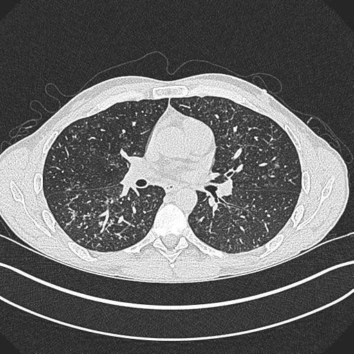 Subacute hypersensitivity pneumonitis | Image | Radiopaedia.org