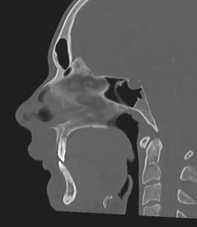 Skull eosinophilic granuloma | Image | Radiopaedia.org