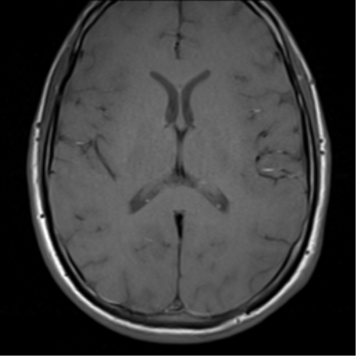 Skull eosinophilic granuloma | Image | Radiopaedia.org