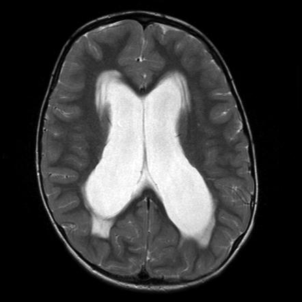 Transependymal oedema | Radiology Reference Article | Radiopaedia.org