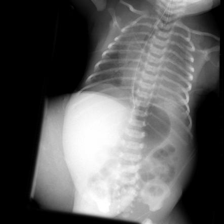 Omphalocele | Radiology Case | Radiopaedia.org