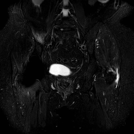 Trochanteric Syndrome | Radiology Reference Article | Radiopaedia.org