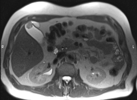 Gallbladder Polyp Radiology Reference Article Radiopaedia Org