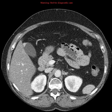 Adenomyomatosis of the gallbladder | Radiology Reference Article ...