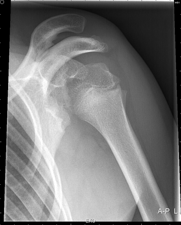 Bilateral posterior shoulder dislocation | Radiology Case | Radiopaedia.org