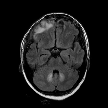 Metronidazole Central Nervous System Toxicity Radiology Reference Article Radiopaedia Org