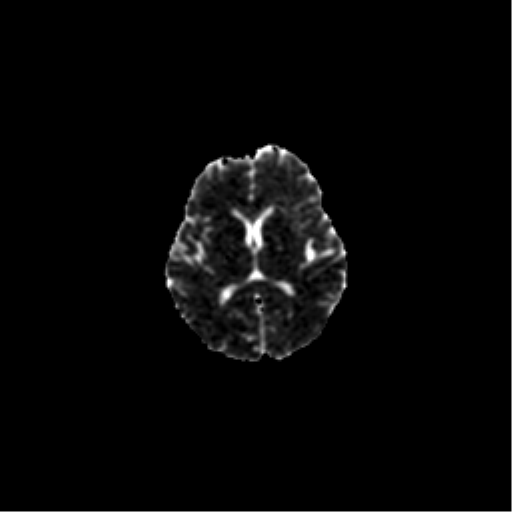 Oligodendroglioma NOS | Image | Radiopaedia.org