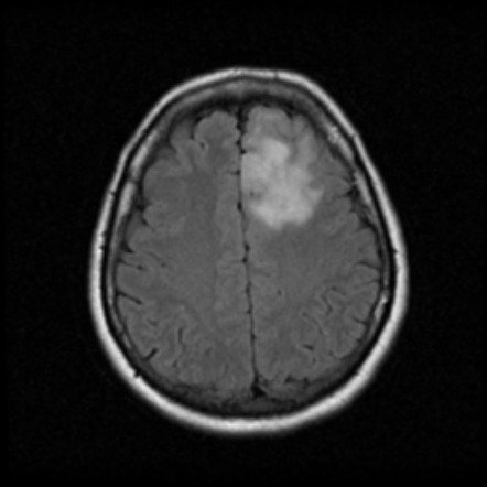 Oligodendroglioma NOS | Radiology Case | Radiopaedia.org