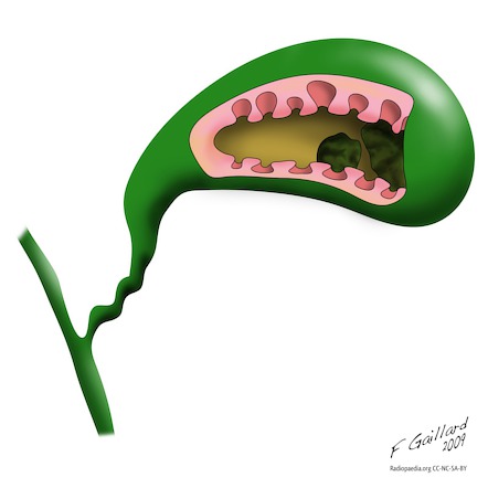 Adenomyomatosis Of The Gallbladder 