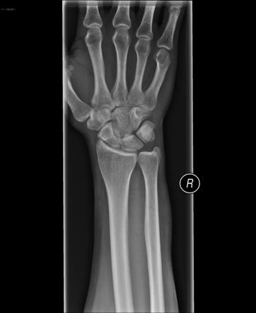 Parry fracture of the ulna | Radiology Case | Radiopaedia.org