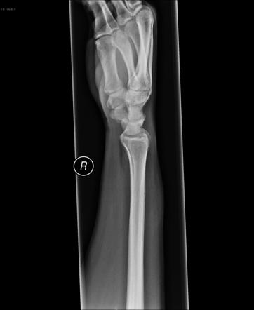 Upper Extremity Fractures 