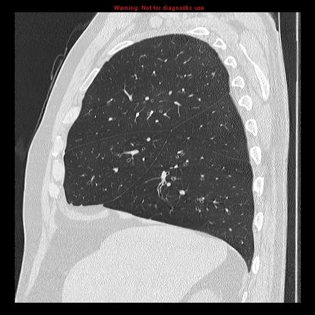 Accessory fissures of the lung | Radiology Reference Article ...