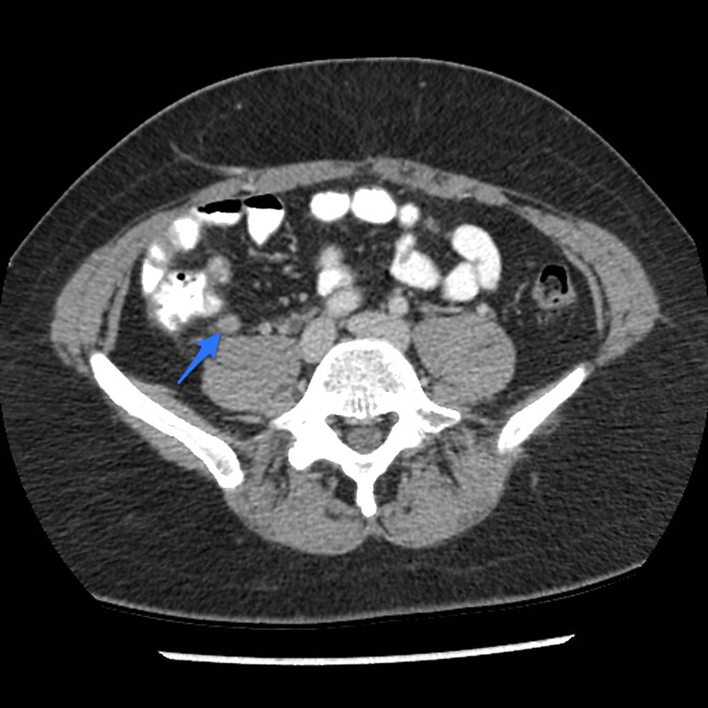 Appendicitis Ct Radiopaedia It Is A Very Common Condition In General