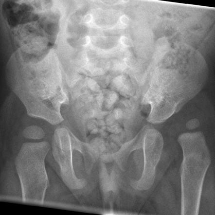 Developmental dysplasia of the hip | Radiology Reference Article ...