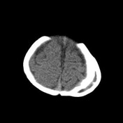 Calcified cephalohematoma | Radiology Reference Article | Radiopaedia.org