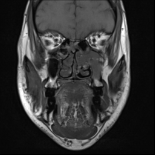 Fibroepithelial sinonasal polyp | Image | Radiopaedia.org