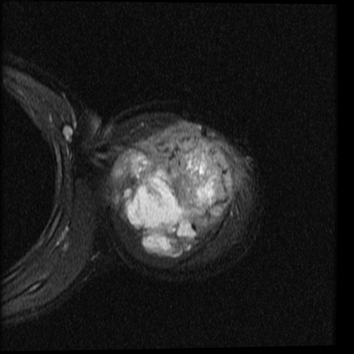 Ewings Sarcoma In Adults 6480