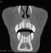 Periapical cyst | Radiology Reference Article | Radiopaedia.org